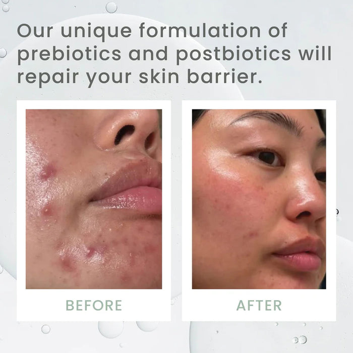Before and after comparison of skin with text about prebiotics and postbiotics repairing the skin barrier.