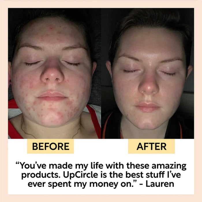 Before and after comparison of a person's face with text praising UpCircle products.