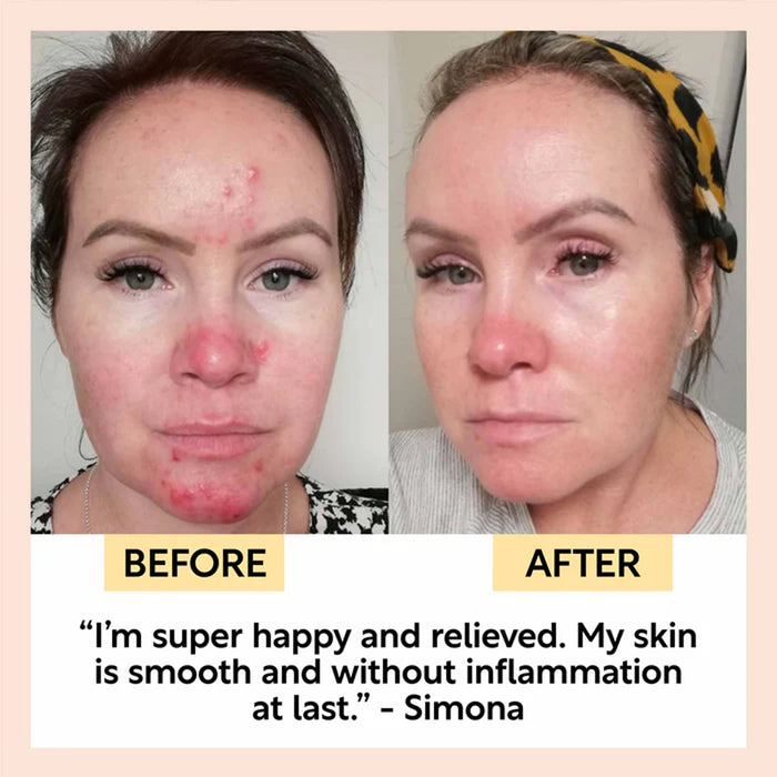Before and after comparison of a woman's face with text indicating improvement in skin condition.